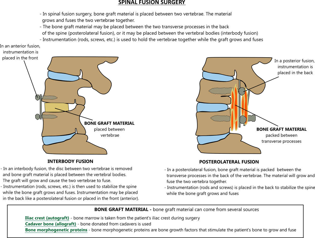 Spinal Fusion Illustration