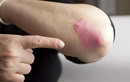 atopic dermatitis on elbow