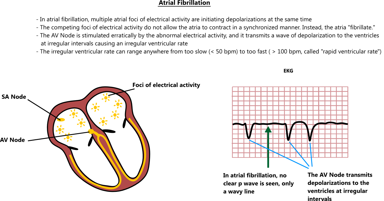 Atrial fibrillation illustration