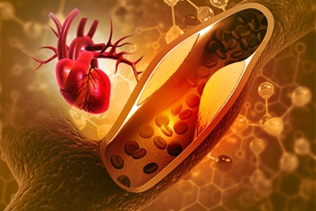 coronary artery blockage