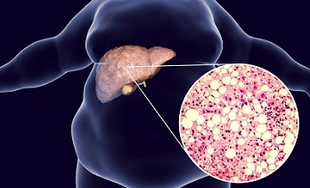 illustration of fatty liver disease