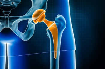 illustration of implanted hip prosthesis