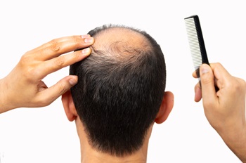 man with androgenic alopecia