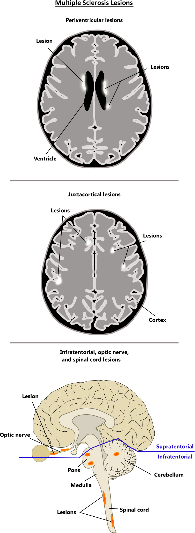 Ms Symptoms Lesions The Radiology Assistant Multiple Sclerosis 